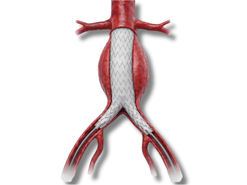 Ilustração de endoprótese para tratamento de aneurisma de aorta