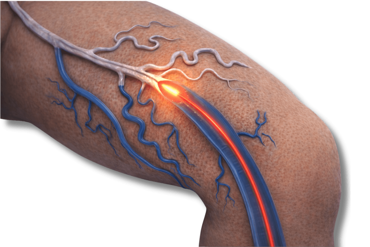 Ilustração do tratamento de varizes com laser endovenoso