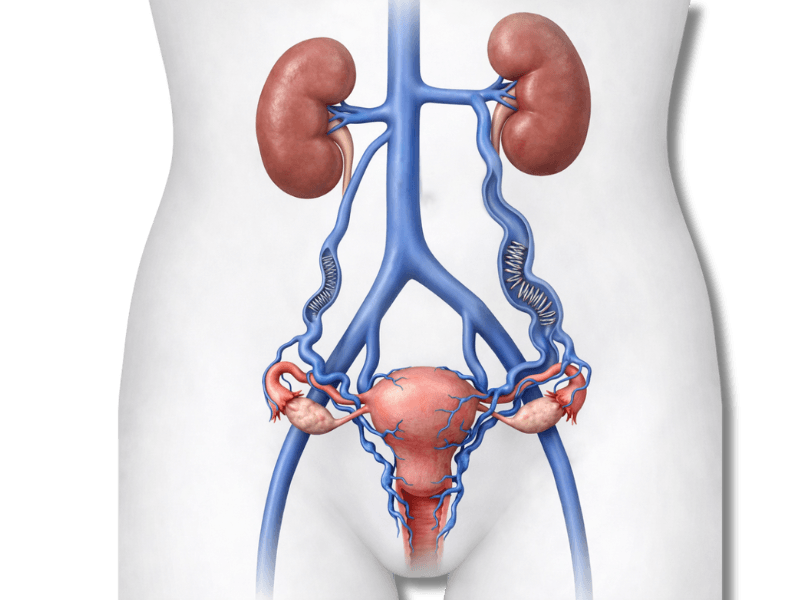 Ilustração de varizes pélvicas mostrando veias dilatadas na região pélvica